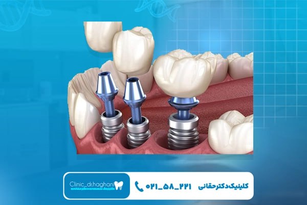 مزیتهای ایمپلنت تخصصی برای سلامت دهان و فک مزیتهای ایمپلنت تخصصی برای سلامت دهان و فک