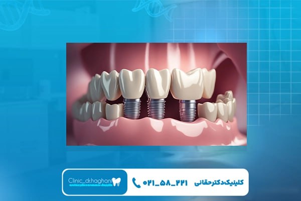 اجزای ایمپلنت دندان چیست؟