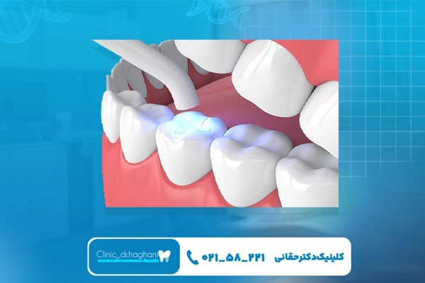 مزیت‌های ایمپلنت دندان نسبت به روش‌های جایگزین قدیمی