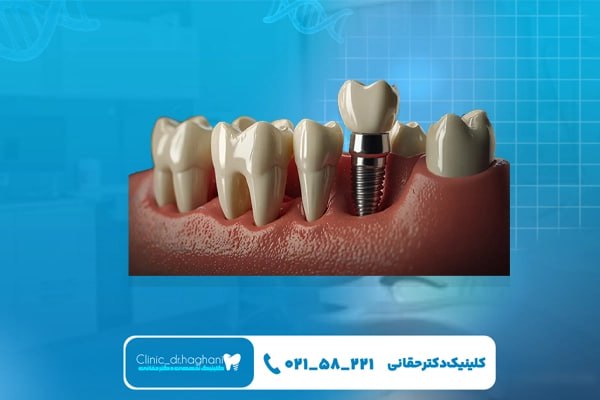 قطعات اصلی ایمپلنت دندان