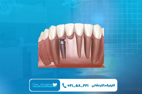 کاشت دندان دیجیتال در برابر کاشت دندان سنتی