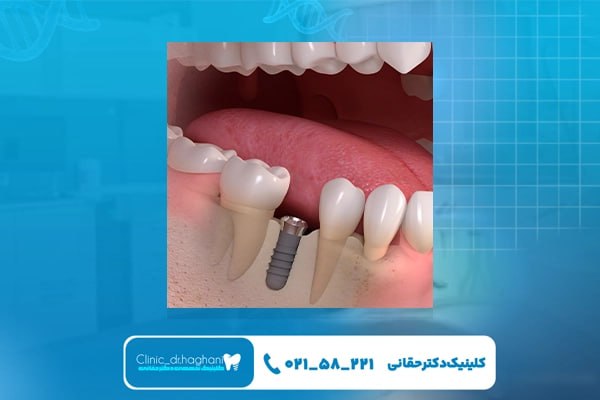 نحوه کاشت ایمپلنت دندان بر اساس شرایط مراجعهکننده