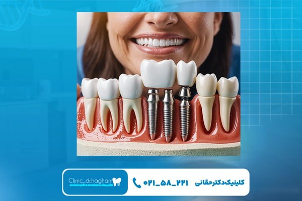 کشیدن دندان آسیبدیده به شیوه اصولی توسط جراح ایمپلنت دندان کشیدن دندان آسیبدیده به شیوه اصولی توسط جراح ایمپلنت دندان