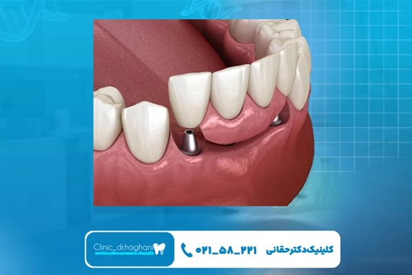 مراحل انجام ایمپلنت دندان به‌صورت تخصصی چیست؟