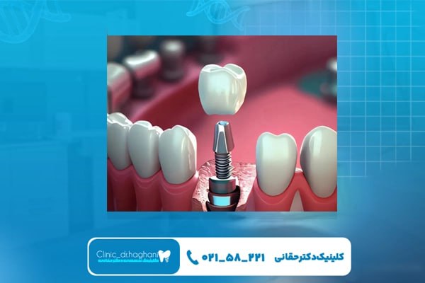 چرا ایمپلنت دندان تحت نظر پزشک متخصص در کلینیک دکتر حقانی را انتخاب کنیم؟