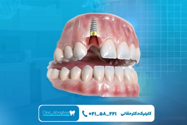 چرا ایمپلنت بدون جراحی در کلینیک دندانپزشکی دکتر حقانی انتخاب مناسبی است؟
