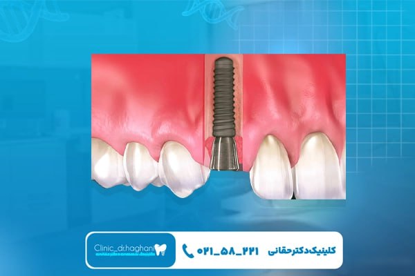 مراحل انجام ایمپلنت دندان سریع مراحل انجام ایمپلنت دندان سریع