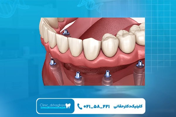 مراحل انجام ایمپلنت دندان فک پایین مراحل انجام ایمپلنت دندان فک پایین