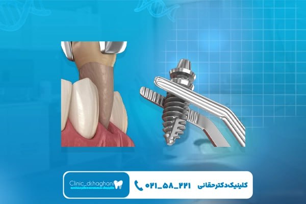 ایمپلنت دندان به صورت تخصصی