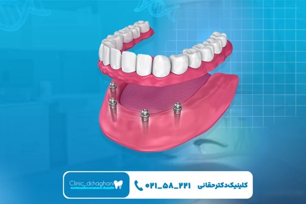 کلینیک تخصصی ایمپلنت دکتر حقانی در تهران کلینیک تخصصی ایمپلنت دکتر حقانی در تهران