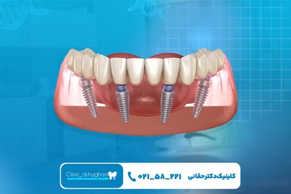 مرکز تخصصی ایمپلنت