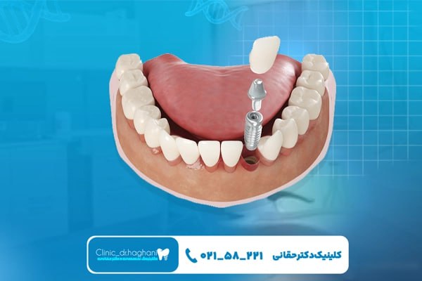 روش جدید کاشت دندان بدون جراحی