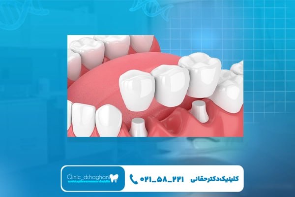 جایگزین مناسب دندان از دست رفته