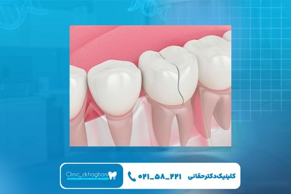 ترمیم دندان‌های شکسته با کامپوزیت در مرکز دندانپزشکی دکتر حقانی