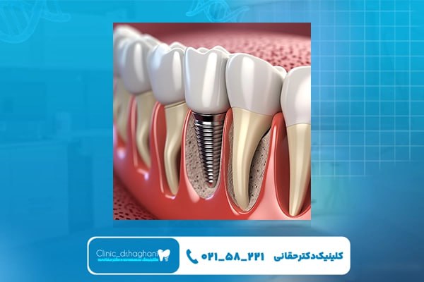 خدمات کاشت دندان در تهران توسط تیم دکتر حقانی خدمات کاشت دندان در تهران توسط تیم دکتر حقانی