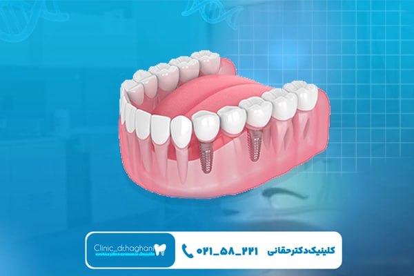 کلینیک تمام دیجیتال ایمپلنت در تهران