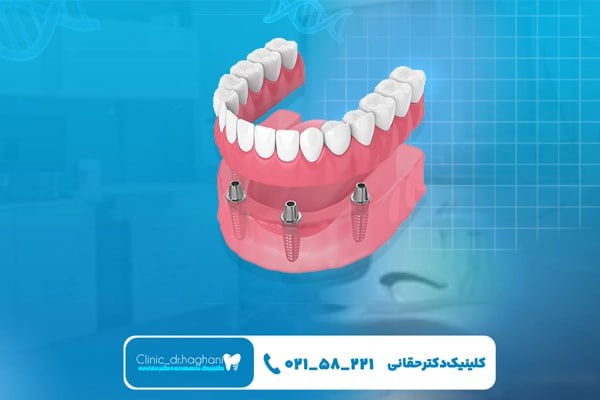 کاشت دندان در جردن کاشت دندان در جردن