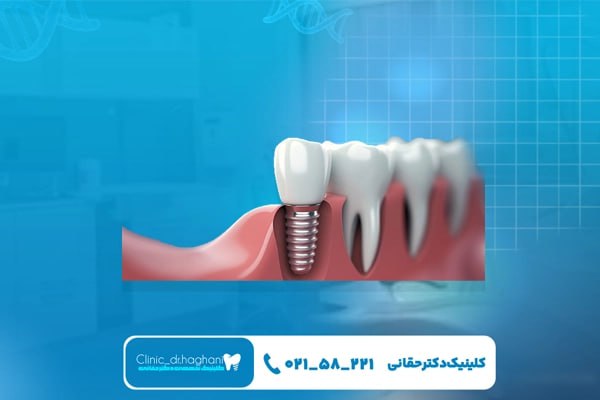 مرکز ایمپلنت در جردن مرکز ایمپلنت در جردن
