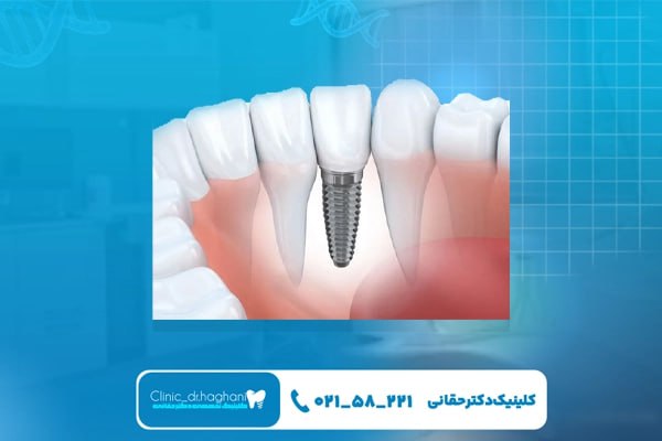 معرفی خدمات دندانپزشکی دیجیتال ایمپلنت در جردن در کلینیک دکتر حقانی