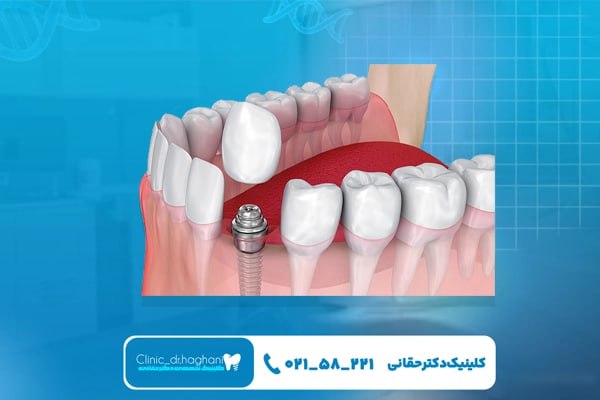 کلینیک دندانپزشکی دکتر حقانی با بهترین ایمپلنت تخصصی تهران کلینیک دندانپزشکی دکتر حقانی با بهترین ایمپلنت تخصصی تهران