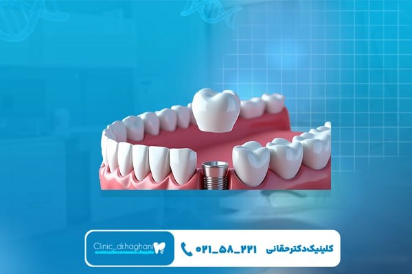 ایمپلنت دندان در خیابان جردن