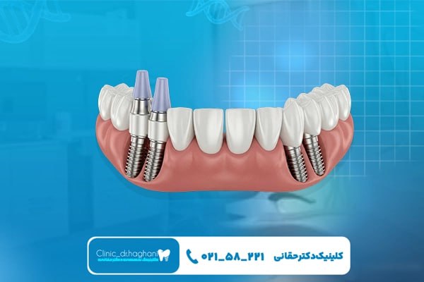 طول عمر ایمپلنت دندان به چه عواملی بستگی دارد؟