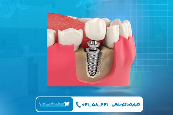 کاشت دندان در کلینیک دندانپزشکی دکتر حقانی چگونه انجام می‌شود؟
