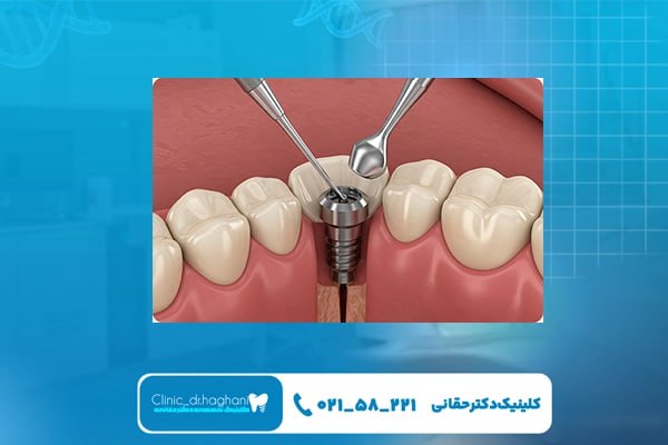 قیمت ایمپلنت تهران در کلینیک دندانپزشکی دکتر حقانی قیمت ایمپلنت تهران در کلینیک دندانپزشکی دکتر حقانی قیمت ایمپلنت تهران در کلینیک دندانپزشکی دکتر حقانی