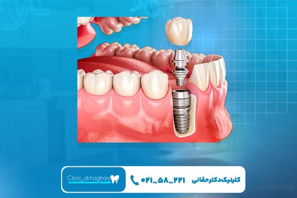 هزینه ایمپلنت تهران هزینه ایمپلنت تهران