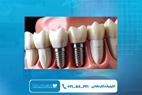 مراحل کاشت پایه ایمپلنت توسط جراح ایمپلنت دندان مراحل کاشت پایه ایمپلنت توسط جراح ایمپلنت دندان