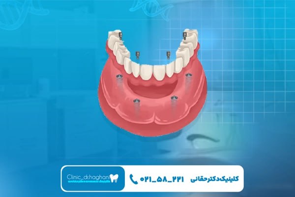 انتخاب دندانپزشک ایمپلنت‌ حرفه‌ای