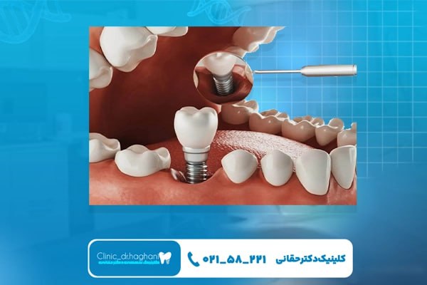 مزیت‌های ایمپلنت دندان در مقایسه با روش‌های جایگزین