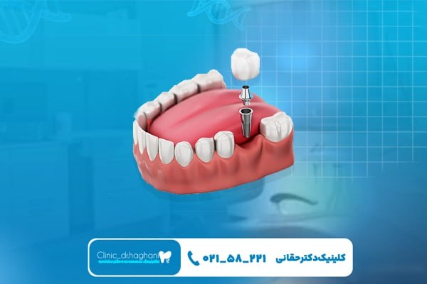 مزیت‌های کاشت بدون جراحی