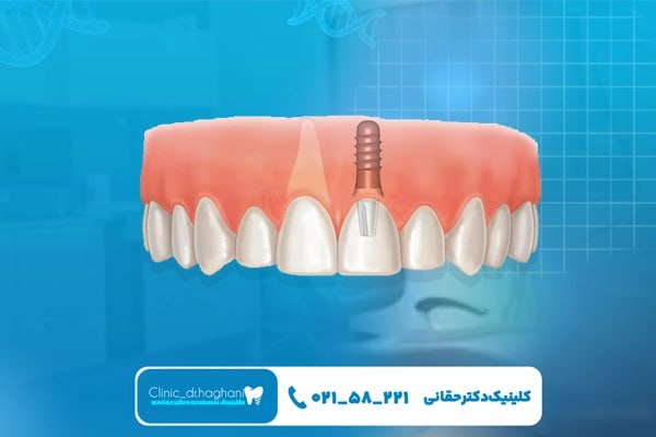 ایمپلنت دندان سریع در کلینیک دندانپزشکی دکتر حقانی چه مزایایی دارد؟ ایمپلنت دندان سریع در کلینیک دندانپزشکی دکتر حقانی چه مزایایی دارد؟