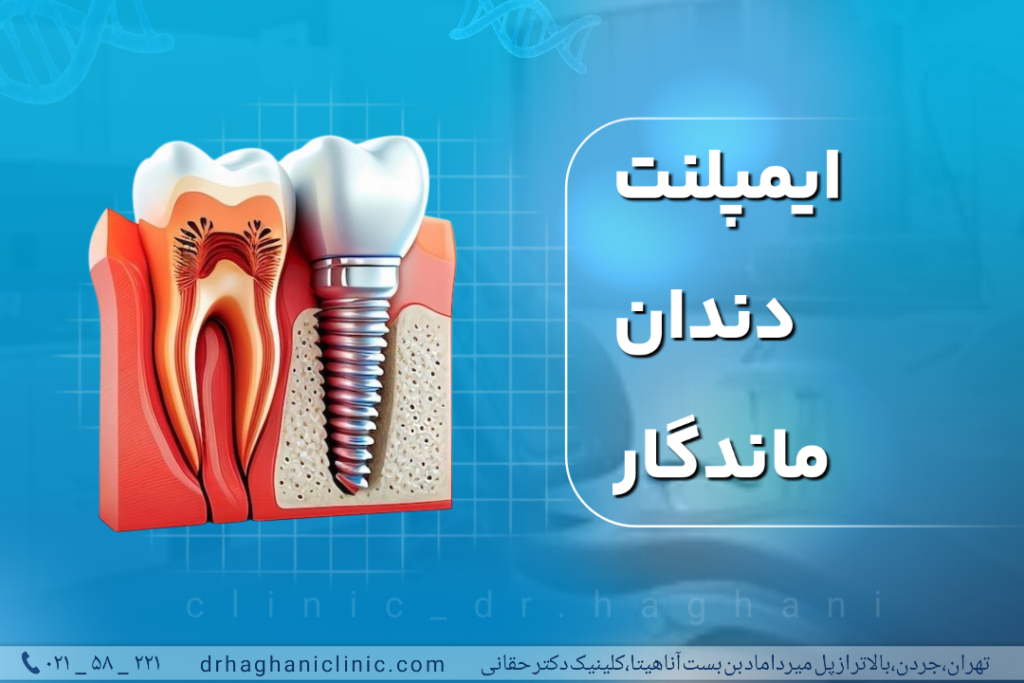 ایمپلنت دندان ماندگار