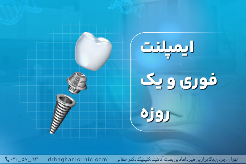 ایمپلنت فوری و یک روزه