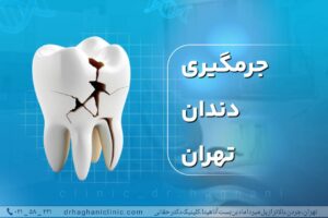 جرمگیری دندان تهران