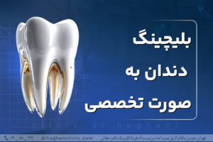 بلیچینگ دندان به صورت تخصصی