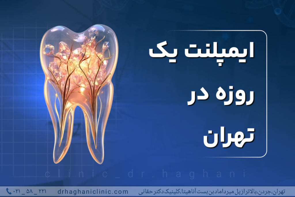 ایمپلنت یک  روزه در تهران