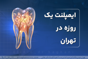 ایمپلنت یک  روزه در تهران