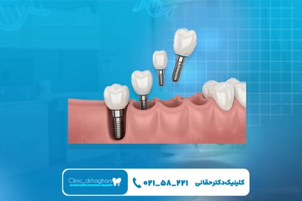 دندانپزشکی تخصصی ایمپلنت تهران
