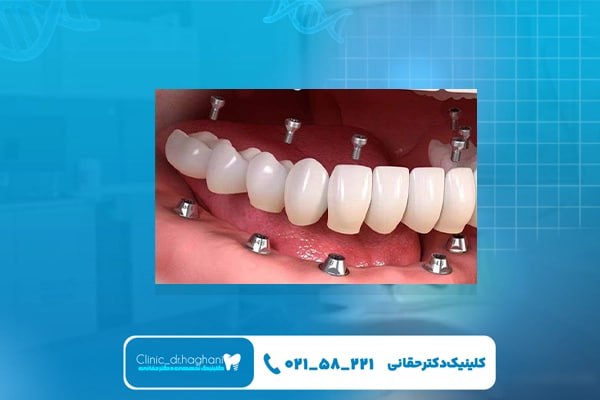 ایمپلنت دندان با مشاوره تخصصی