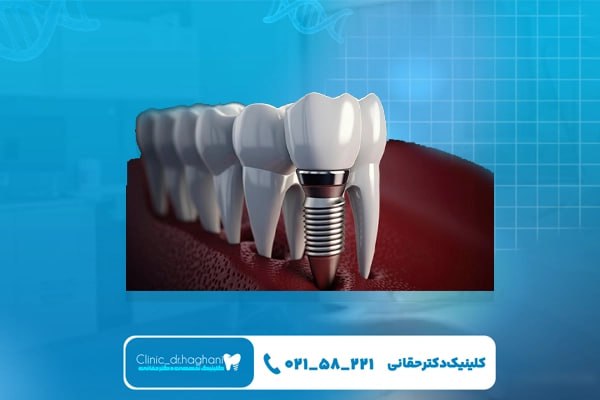 سخت‌ترین مرحله ایمپلنت دندان چیست؟