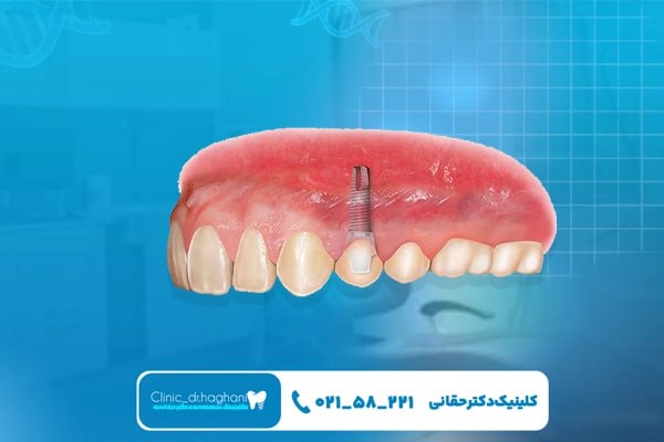 ایمپلنت دندان با استاندارد جهانی