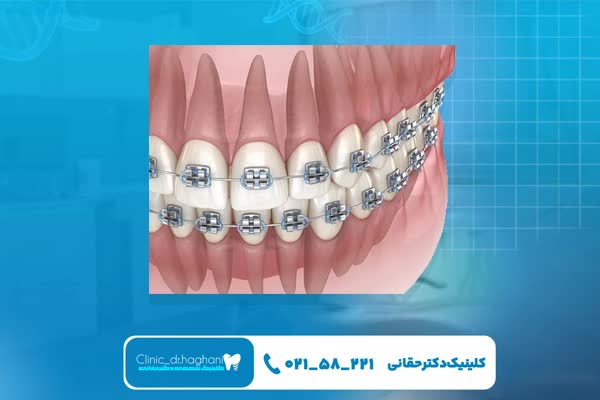 مزایای ارتودنسی دیجیتال