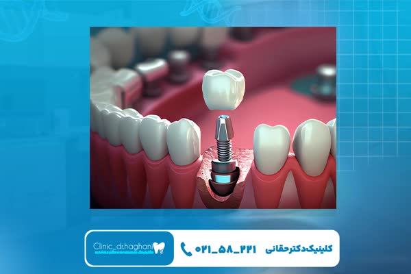 بهترین دندانپزشکی ایمپلنت شمال تهران