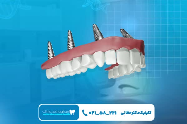 جراحی‌‌های مکمل ایمپلنت دندان