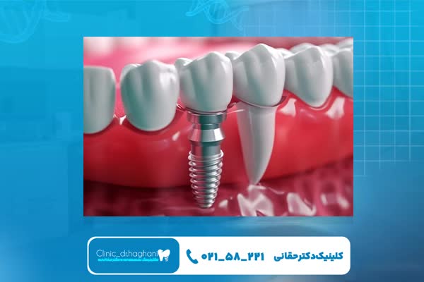 ایمپلنت دندان با طراحی دیجیتال