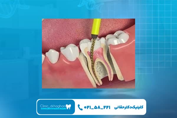 عصب کشی بدون درد عصب کشی بدون درد