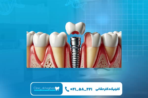 ایمپلنت دندان با نتیجه قطعی